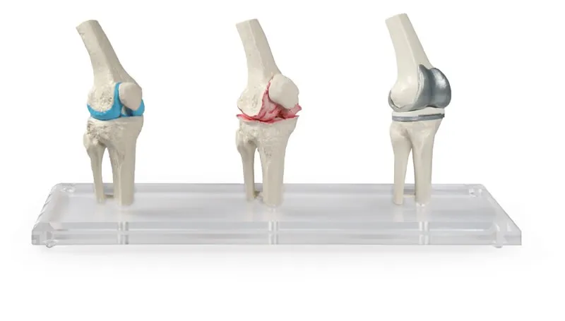 Knie-Implantat-Modell Knie-Implantat-Modell