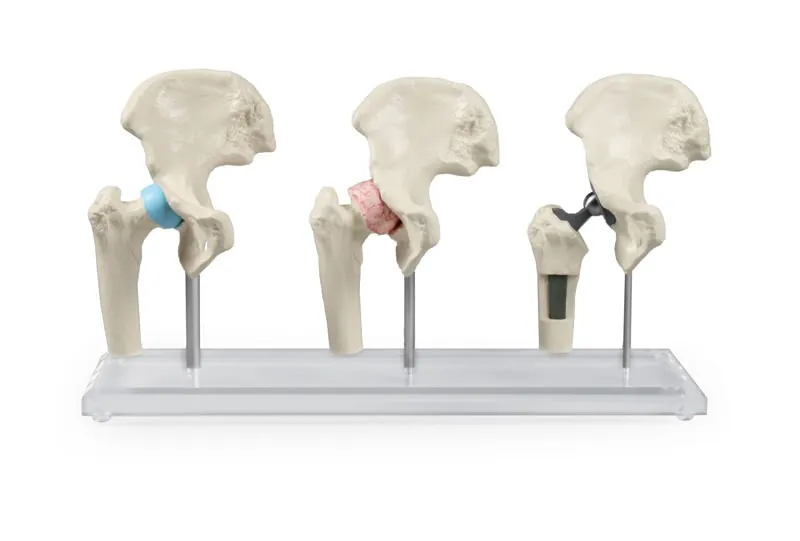 Hüft-Implantat-Modell Hüft-Implantat-Modell